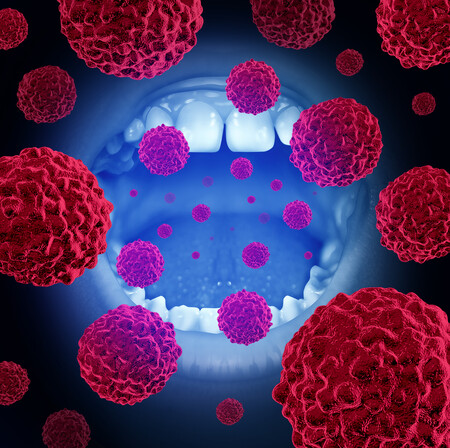 Oral cancer medical concept as a mouth with malignant disease cells with 3D illustration elements.